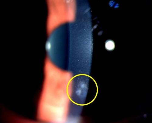 세극동현미경으로 촬영한 각막혼탁 [온누리스마일안과 제공]