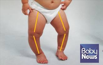 내반슬 환아의 모습. ⓒ정기진