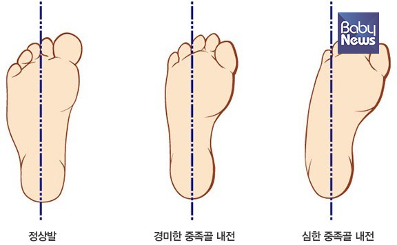 정상발과 중족골 내전증. ⓒ정기진