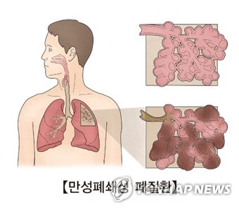 만성 폐쇄성 폐 질환(COPD) [서울아산병원 제공. 연합뉴스 자료사진]