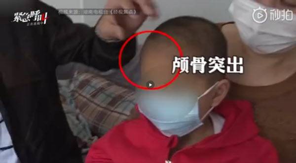 중국 후난성에서 발생한 가짜 분유 파동의 피해 아동 모습/신징바오