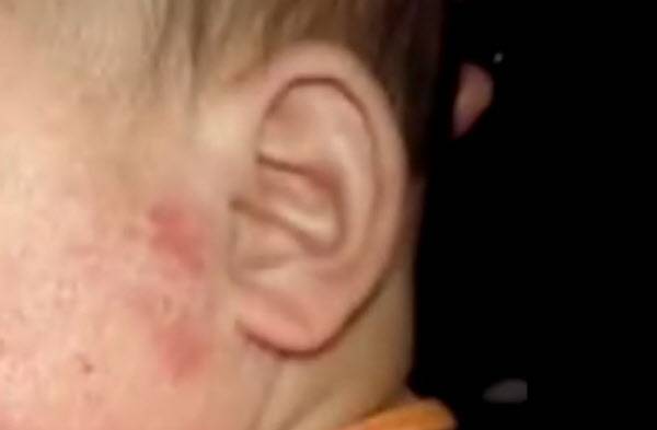 중국 후난성에서 발생한 가짜 분유 파동의 피해 아동이 습진에 걸린 모습/신징바오