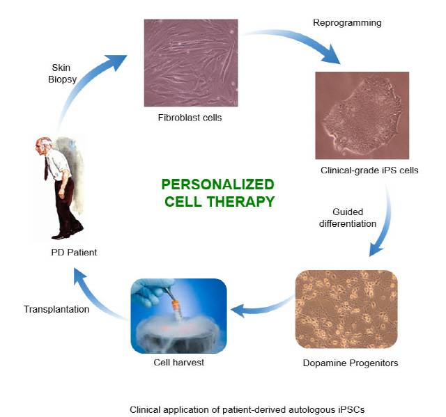 맞춤형 줄기세포를 활용한 파킨슨병 치료 과정 모식도.우선 환자의 섬유아세포(fibroblast cell)을 ‘유도만능 줄기세포(iPS)’상태로 역분화시킨다. 이를 다시 도파민을 분비하는 세포를 생산할 수 있는 전구세포(dopamine progenitor)로 분화시킨 뒤 세포배양(cell harvest)해 환자의 뇌에 이식한다. /자료제공=KAIST