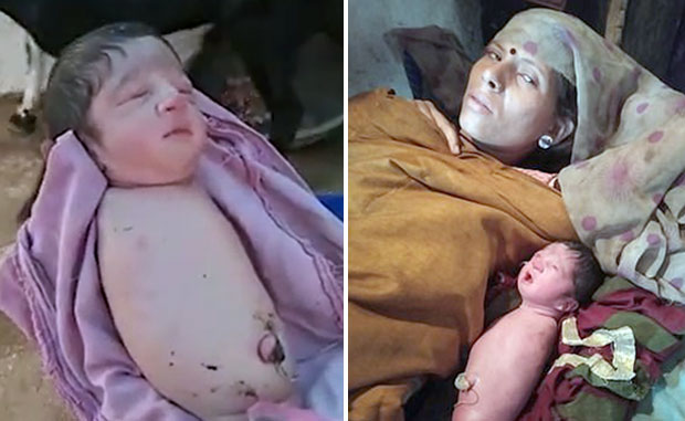 인도에서 팔다리 없는 아기가 태어났다. 27일(현지시간) 데일리메일은 인도 마디아프라데시 주에서 ‘테트라 아멜리아 증후군’을 동반한 아기가 태어났다고 전했다.