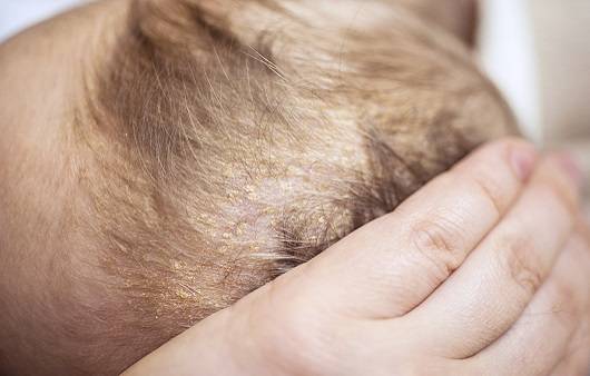 유아지방관이란?