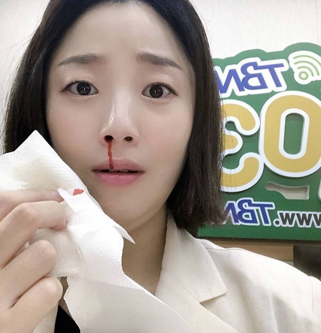 ▲ 허민이 공개한 코피 '인증샷'. 출처ㅣ허민 SNS