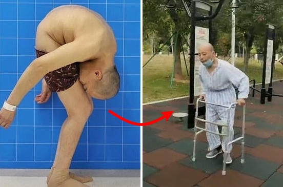 사진 왼쪽은 지난해 6월 수술 받기 직전의 모습, 오른쪽은 수술을 성공적으로 마친 뒤 20여 년 만에 허리를 편 채 스스로 걷는 리 씨의 모습