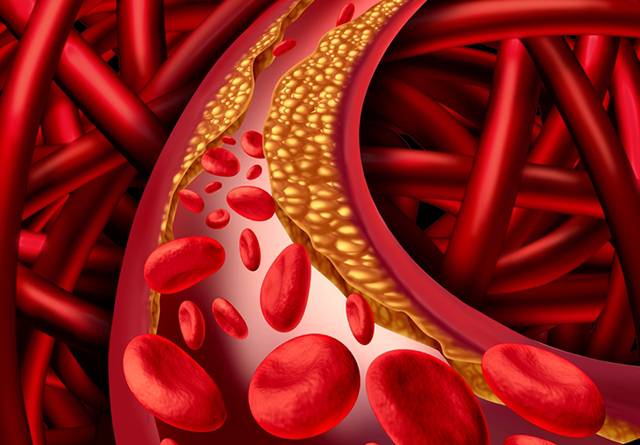 뇌경색이 발생했다면 뇌혈관뿐 아니라 전신 혈관을 점검해야 재발을 막을 수 있다./사진=게티이미지뱅크