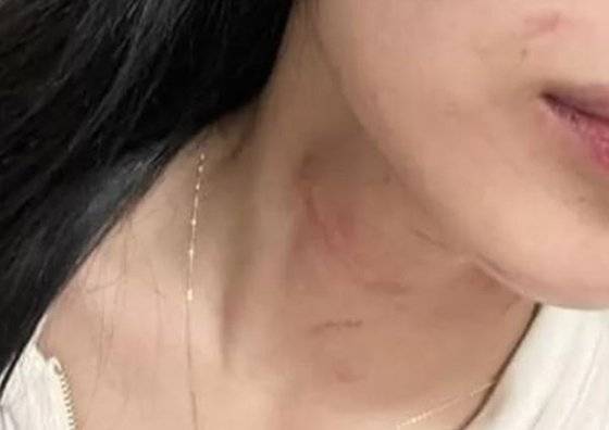 유화가 공개한 데이트 폭력 피해 사진. 아프리카TV