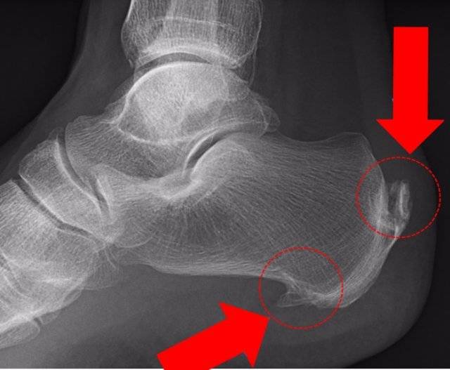 무리한 운동으로 발뒤꿈치 쪽에 골극(뼈까시)이 생긴 사례. 뒤 골극이 아킬레스건염을 유발하는 골극이다. 강남제이에스병원 제공.