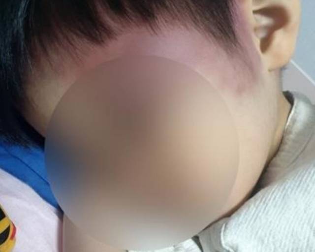 피해 아동의 얼굴에 남은 폭행의 흔적. 연합뉴스, 피해 아동 친부 제공