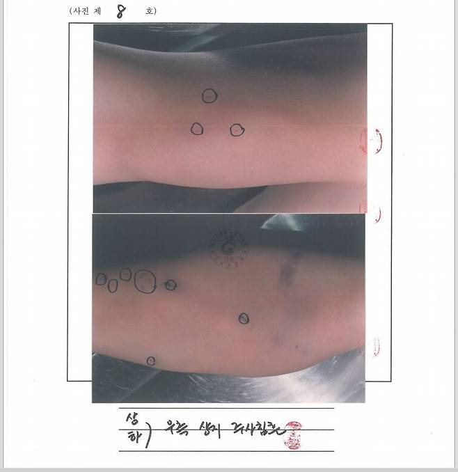 부검감정서에 편철된 김성재 오른팔 주사 자국 사진. 부검의는 28개나 되는 자국 중 정맥을 따라 놓으려고 한 주사 부위에 출혈이 많은 편이었는데 정맥을 제대로 찌르지 못하는 과정에서 혈관이 손상돼 출혈이 많았던 것으로 봤다. 유족 제공