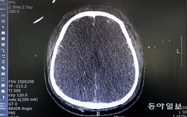 손현승 씨의 뇌 컴퓨터단층촬영(CT) 사진. 하얗게 보여야 할 뇌실과 주름이 전혀 없고 모든 부분이 검게 변해 있다. 부산=곽도영 기자 now@donga.com