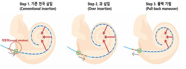 풀백 수술 기법. (사진=분당서울대병원 제공) *재판매 및 DB 금지