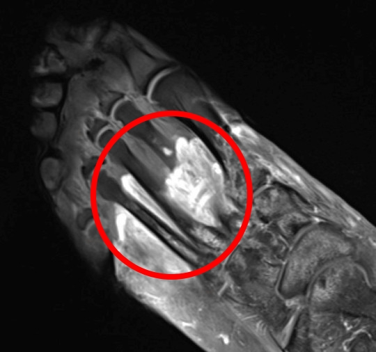 발 세포가 괴저(붉은 동그라미)된 코로나19 환자의 발 MRI. 노스웨스턴대학 제공