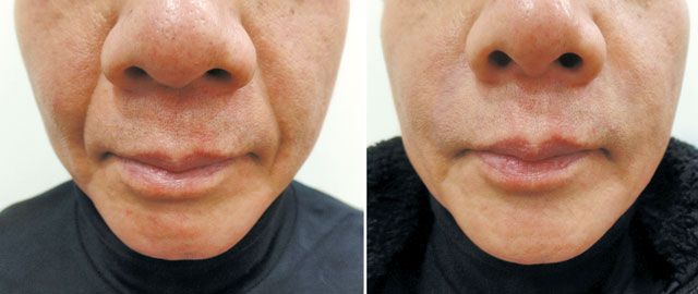 ‘제이(J)자가진피재생술’을 받은 환자의 입가 주름 전후 사진. /진성형외과 제공