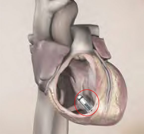 무선 인공심박동기(붉은 원 안)가 심장에 삽입된 이미지.