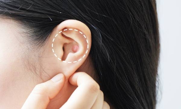 귀에 작게 잡히는 멍울은 '표피낭종'일 확률이 크다./사진=헬스조선 DB