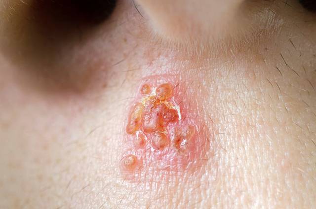 여드름으로 오인하기 쉬운 단순포진은 전염성이 있다./사진=클립아트코리아
