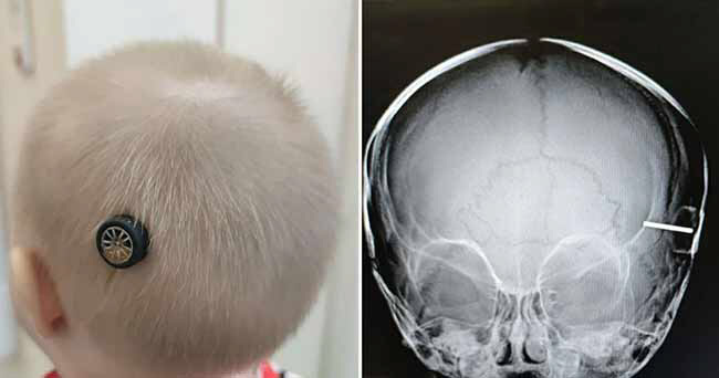 10개월 아이의 머리에 장난감 바퀴가 박혀있다 (사진=스페란스키 소아병원)