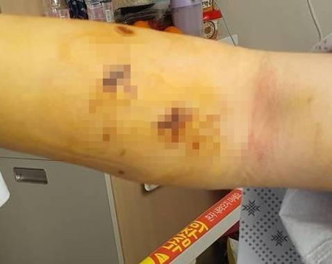 B씨의 부상 사진. B씨 인스타그램