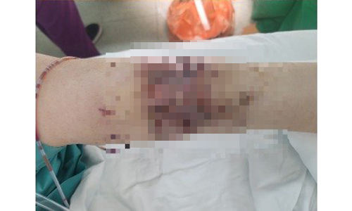 지난 2월7일 발생한 개물림 사고로 A씨는 팔과 다리에 총 6번의 수술을 받았다. 피해자 제공/중앙일보