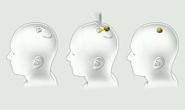 뉴럴링크의 뇌-기계 인터페이스 기술은 뇌에 전극을 심은 다음 칩을 사용하여 두개골 바깥에서 컴퓨터와 통신한다. (사진=씨넷)