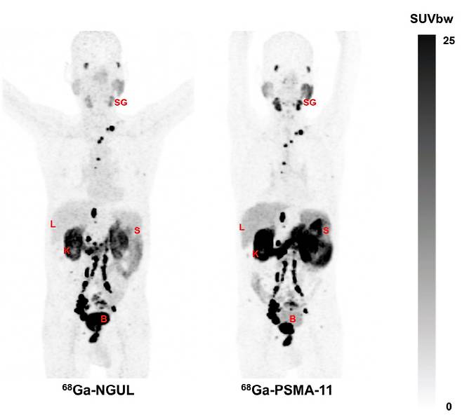 전이 전립선암 환자에게 PSMA-NGUL을 주입한 경우(좌)와 PSMA-11을 주입한 (우) 경우의 PET/CT 영상. 좌측 PSMA-NGUL은 전립선암의 원발병소(전립선), 임파절 전이병소, 뼈전이 병소가 뚜렷하고, 다른 장기들이 훨씬 흐리게 보여 보다 명확하게 진단할 수 있다.