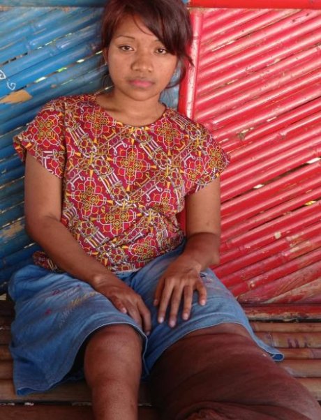 인도네시아의 한 여성이 상피병을 앓고 있다. 사진=온라인 모금 kitabisa 사이트 캡처.
