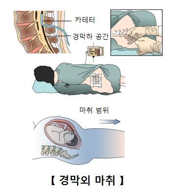 경막외 마취. 서울아산병원 제공