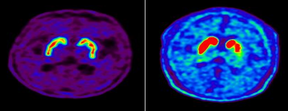 정상인의 뇌(왼쪽)와 파킨슨병 환자의 뇌 핵의학 영상. 파킨슨병 환자의 뇌는 도파민 분비 부위가 퇴하돼 있다. [사진=서울아산병원]