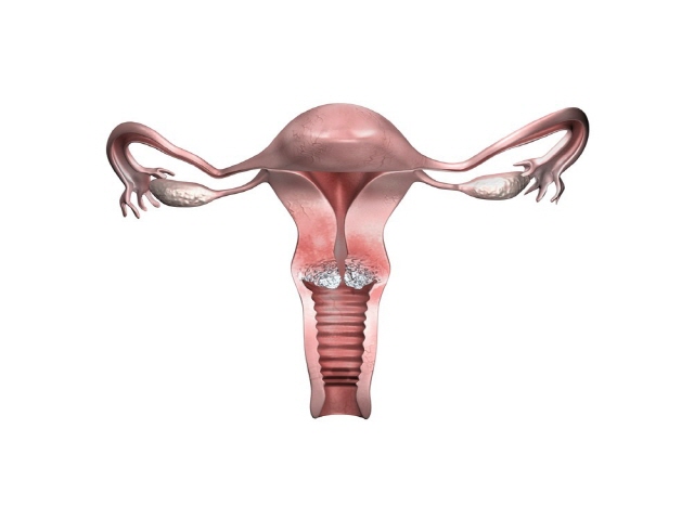 자궁경부는 자궁의 아래쪽과 질이 연결되는 부분, 즉 자궁의 입구를 말한다. 자궁경부암은 바로 이곳에 발생하는 악성종양이다./클립아트코리아 제공