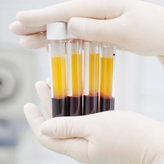 순수한 혈장만 깔끔하게 분리하는 기술 나왔다 - 혈액은 혈구(적혈구, 백혈구, 혈소판)와 혈장으로 구성돼 있다. 옅은 담황색 액체인 혈장에는 단백질 성분이 많아 바이오마커로 사용되기도 하고 코로나19와 같은 질병 치료에도 활용된다. 국내 연구진이 혈구성분이 섞이지 않은 100% 혈장을 분리할 수 있는 기술을 개발해 주목받고 있다.