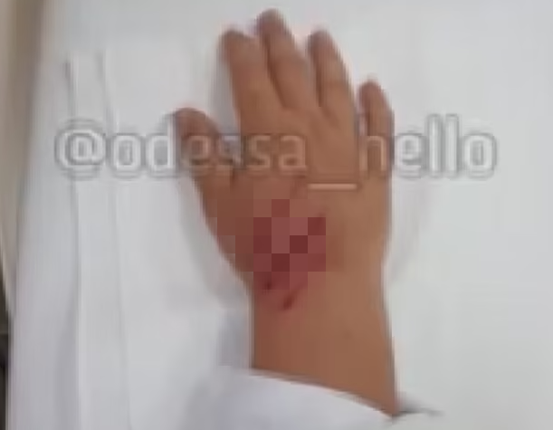 우크라이나의 한 아쿠아리움에서 돌고래가 수족관 안으로 들어온 아이의 손을 덥석 무는 사고가 발생했다. 치료를 받고 있는 아이의 손