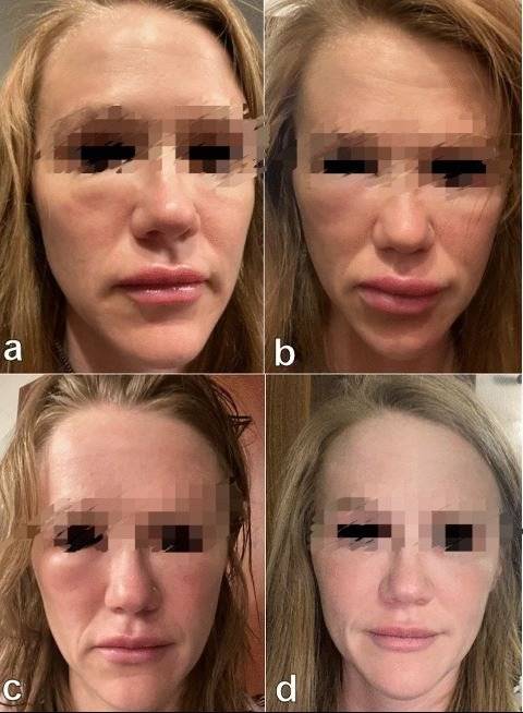 미국 노스캐롤라이나의 웨이크포레스트대 연구팀이 지난 2월 낸 논문에 실린 모더나 접종 이후 부종 보고 사례. 접종 36시간 뒤 부종(a)이 나타나기 시작해, 접종 48시간 뒤(b)더 심해졌고, 60시간 뒤(c)나아지기 시작해 72시간이 경과(d)하자 거의 가라앉은 것으로 보인다.