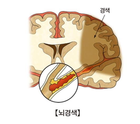 뇌경색 [출처: 서울아산병원]