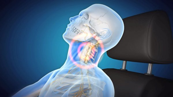 교통사고 발생시 편타성 손상으로 목과 허리의 통증이 발생할 수 있다.