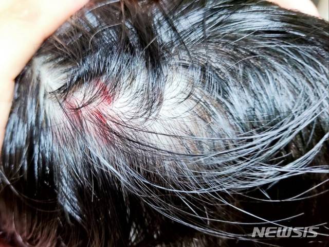 [서울=뉴시스] 경남 사천에 위치한 어린이집에 다니는 B(당시 5세)군의 머리에 난 상처. B군의 모친은 지난해 9월15일 이같은 상처를 발견하고 어린이집에 폐쇄회로(CC)TV 영상을 요청했다. 2020.10.28. (사진 = B군 측 제공)