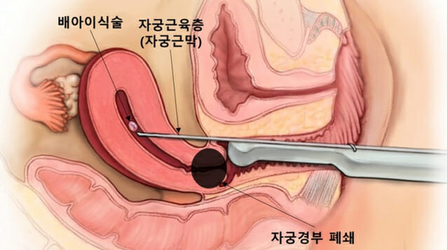 자궁근막 통과 배아이식술. (일러스트=분당서울대병원)