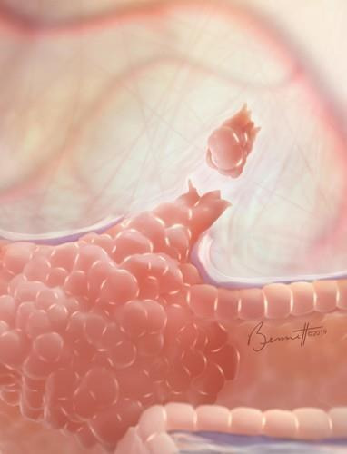 유방암 종양에서 분리되는 CTCs 이미지  [미국 존스홉킨스의대 / 재판매 및 DB 금지]