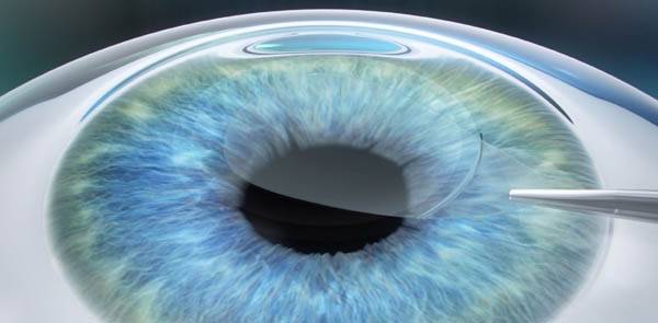 스마일라식 수술 과정 중 각막 실질을 꺼내는 장면(가상도) / 아이러브안과 제공