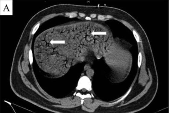 콜라 1.5리터를 10분 만에 마신 중국 남성의 CT 결과. 화살표는 간문맥 등에 가스가 찬 모습을 가리킨다. [트위터 캡처]