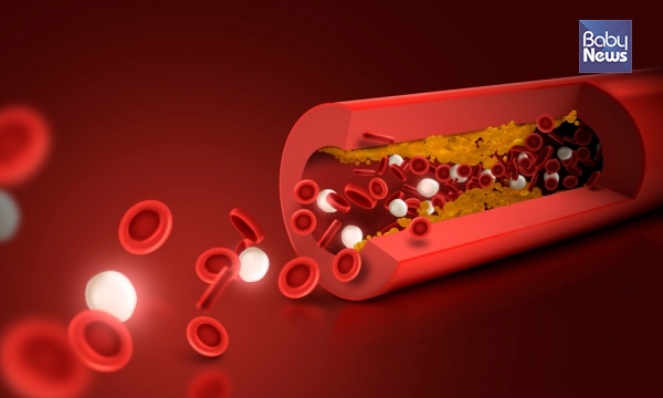 김인섭 경희대병원 교수는 "과거 스텐트 시술이 없었던 시기에는 수술적 치료가 주된 치료였으나 현재는 약 80~90% 환자에서 경피적 시술이 이뤄진다"고 밝혔다. ⓒ베이비뉴스