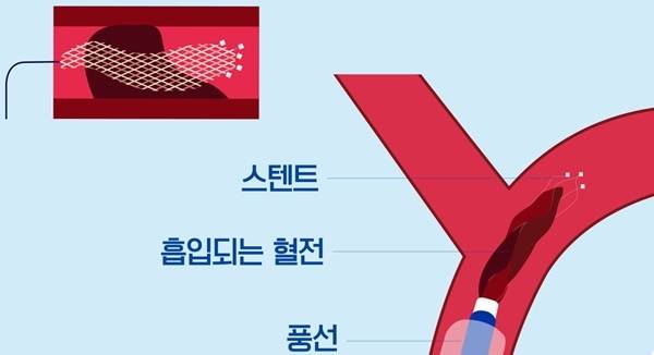 기계적 혈전제거술 방법