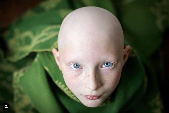 전신성 탈모증을 앓는 한나 프레이(17)의 11살 때 모습. 인스타그램 캡처