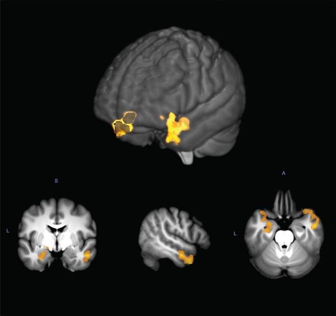 헥사데카날에 노출된 후 남성과 여성의 반응이 가장 차이가 났던 뇌 영역(노란색). 와이즈만과학연구소 제공