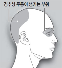 경추성 두통이 생기는 부위/헬스조선 DB