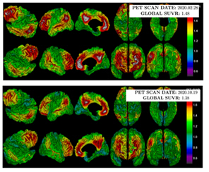 뇌혈관장벽 개방술 전(위), 후(아래) 아밀로이드 PET 검사 결과, 후 사진에서 아밀로이드 양과 범위(회색+빨간색)가 감소한 것을 확인할 수 있다./세브란스병원 제공