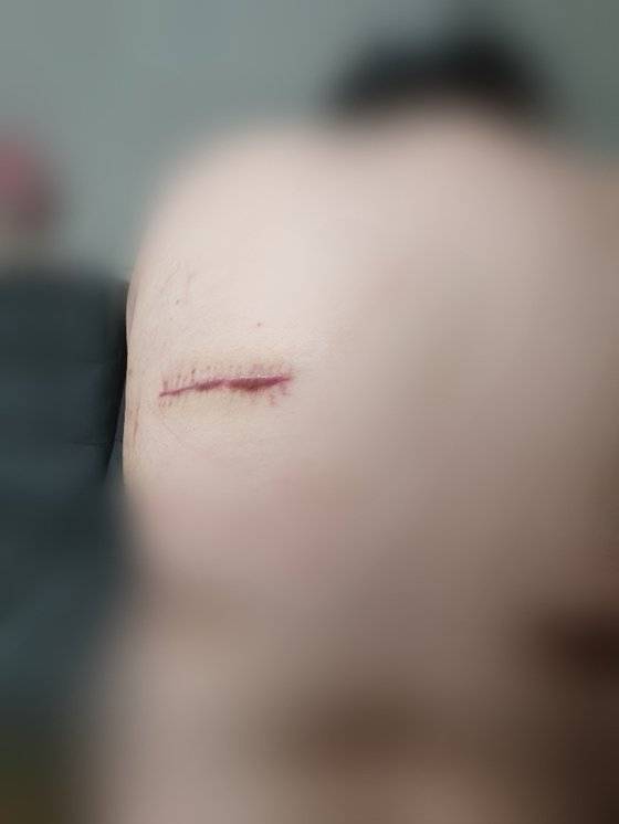 남편으로부터 등쪽 날개뼈 부위에 식칼로 찔린 아내의 상처. 갈비뼈를 관통해 늑간 근육과 동·정맥이 파열된 아내는 봉합 수술을 받았다. 피해 여성 제공