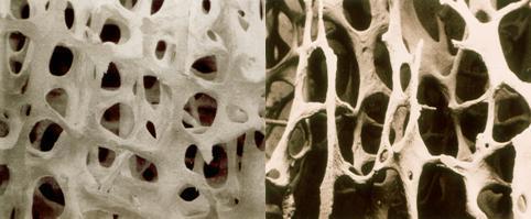 정상인의 뼈(왼쪽)와 골다공증 환자의 뼈.